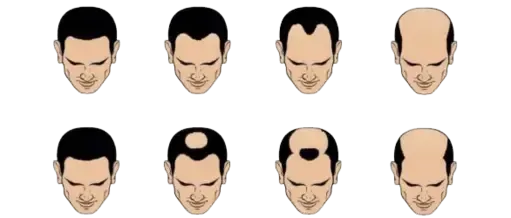 a cartoon of a man 's head with different types of hair loss