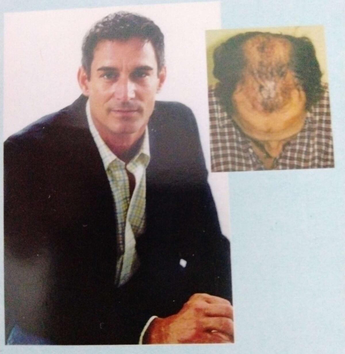 Hair Transplants Before and After