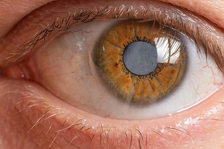 Cataract & Lens-Based Surgery Cataract & Lens-Based Surgery