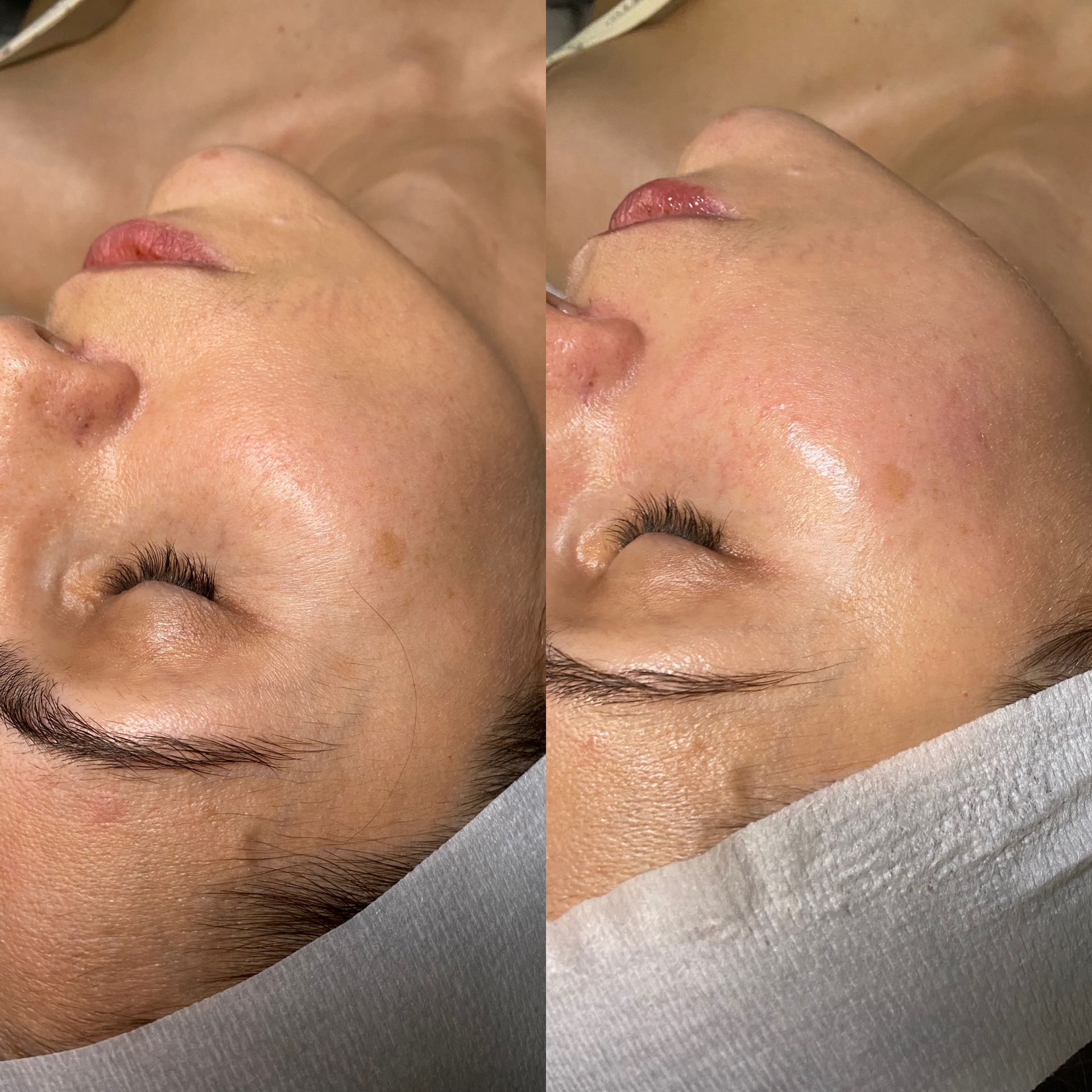 a woman with before and after a treatment