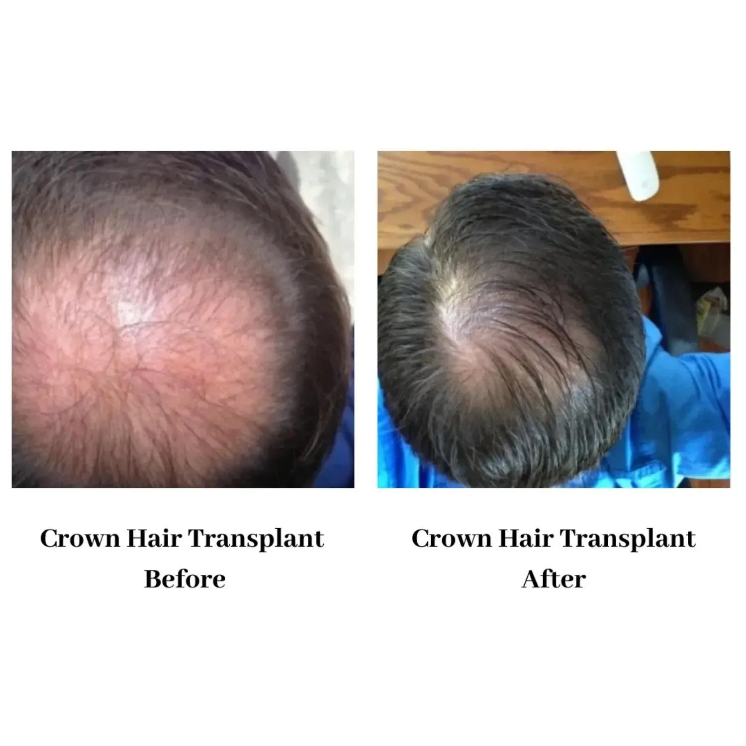 Hair transplant before and after
