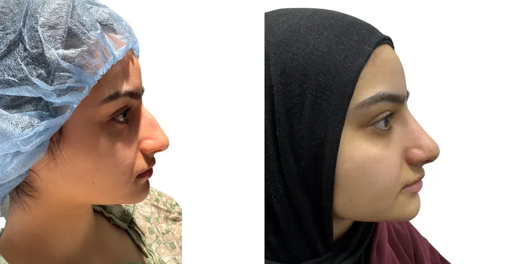 Rhinoplasty before and after englewood