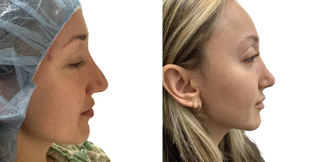 Rhinoplasty before and after englewood