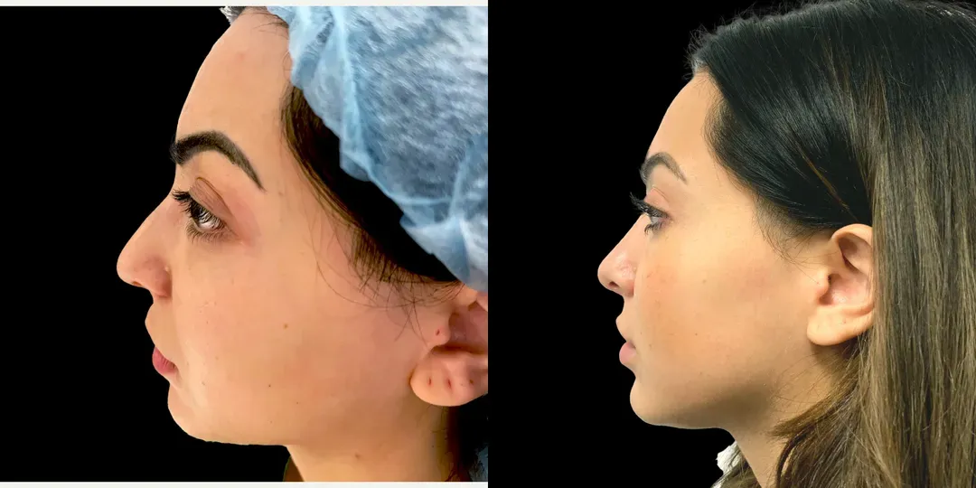 Rhinoplasty before and after englewood
