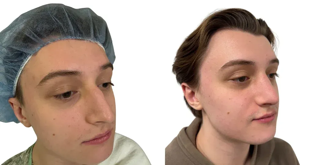Rhinoplasty before and after englewood