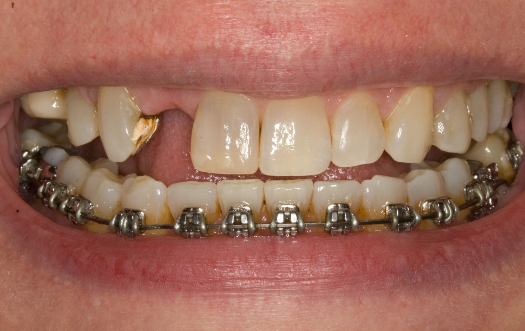 Close-up of teeth with braces and visible gaps, showing a smile.