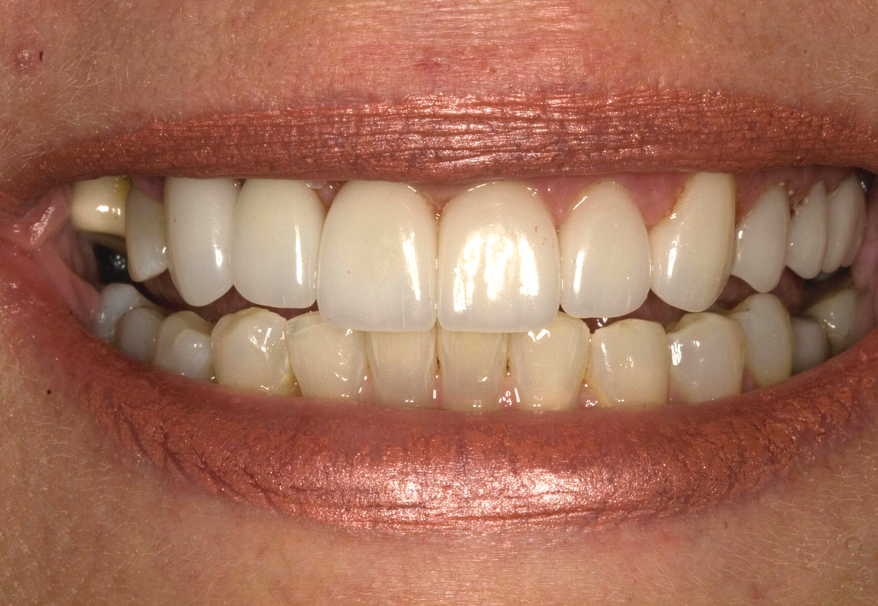 Close-up of a smiling mouth showing white teeth with a gap between the front teeth