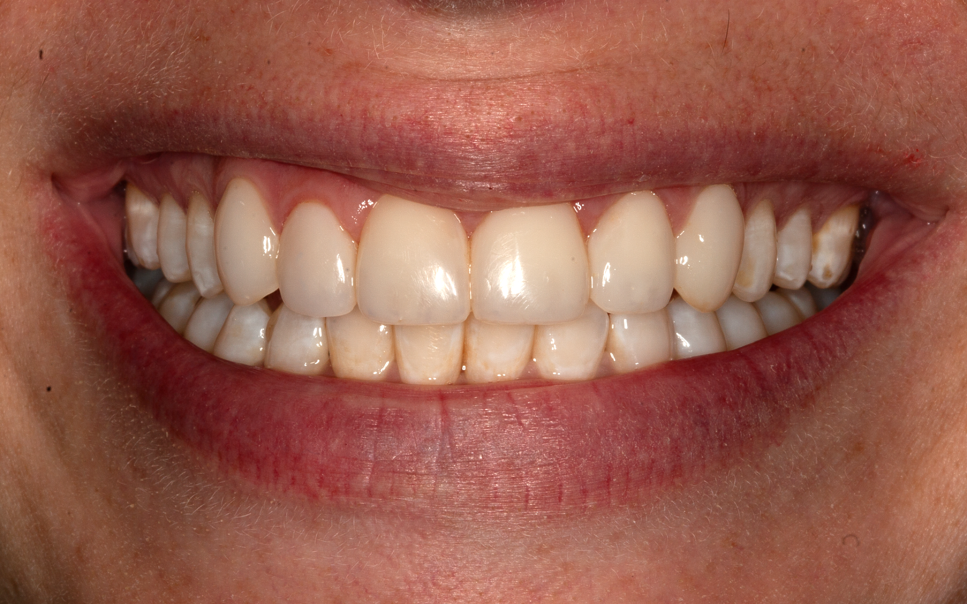 Close-up of a smiling mouth showing white teeth and pink lips