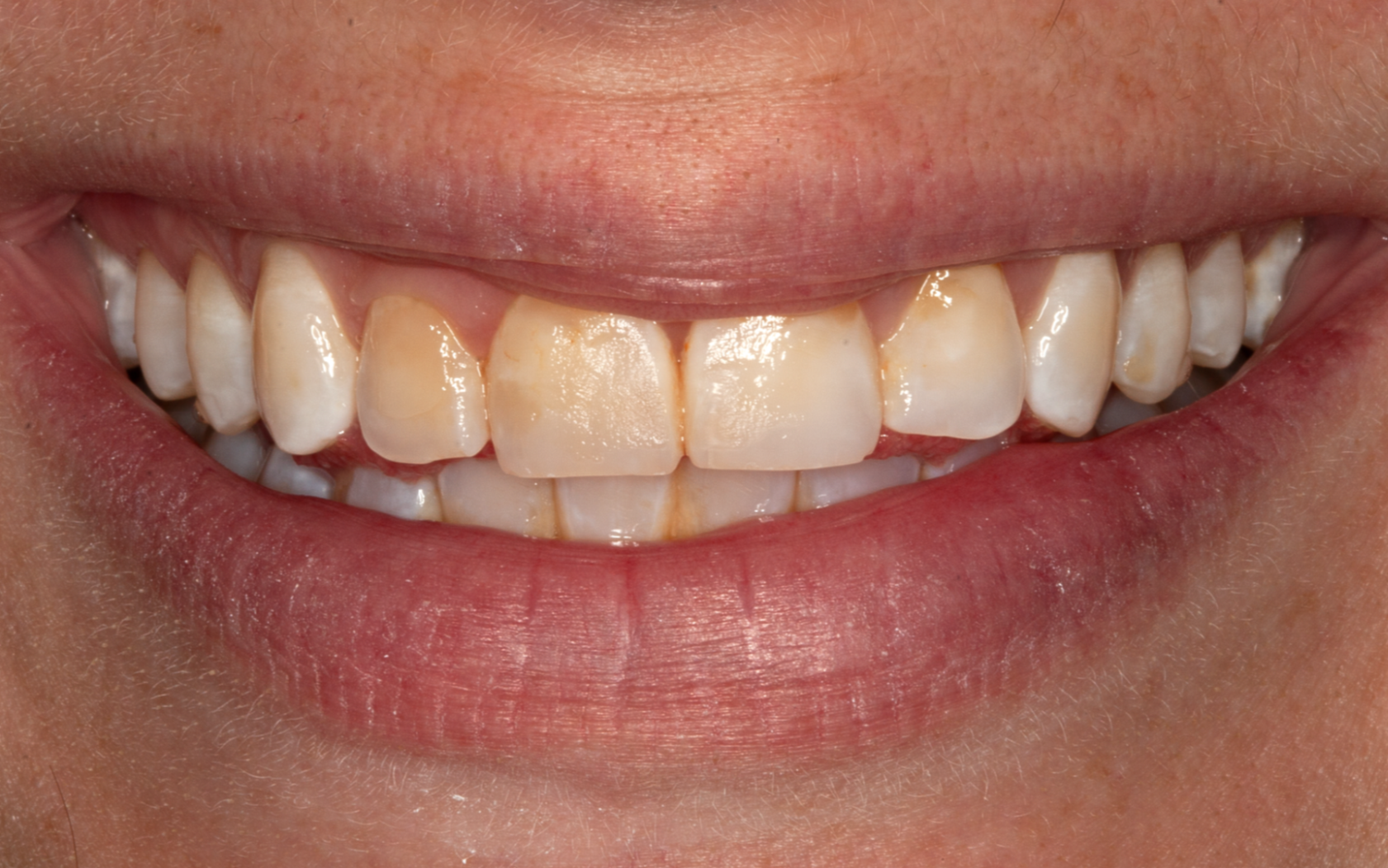 Close-up of a smiling mouth with white teeth and pink lips
