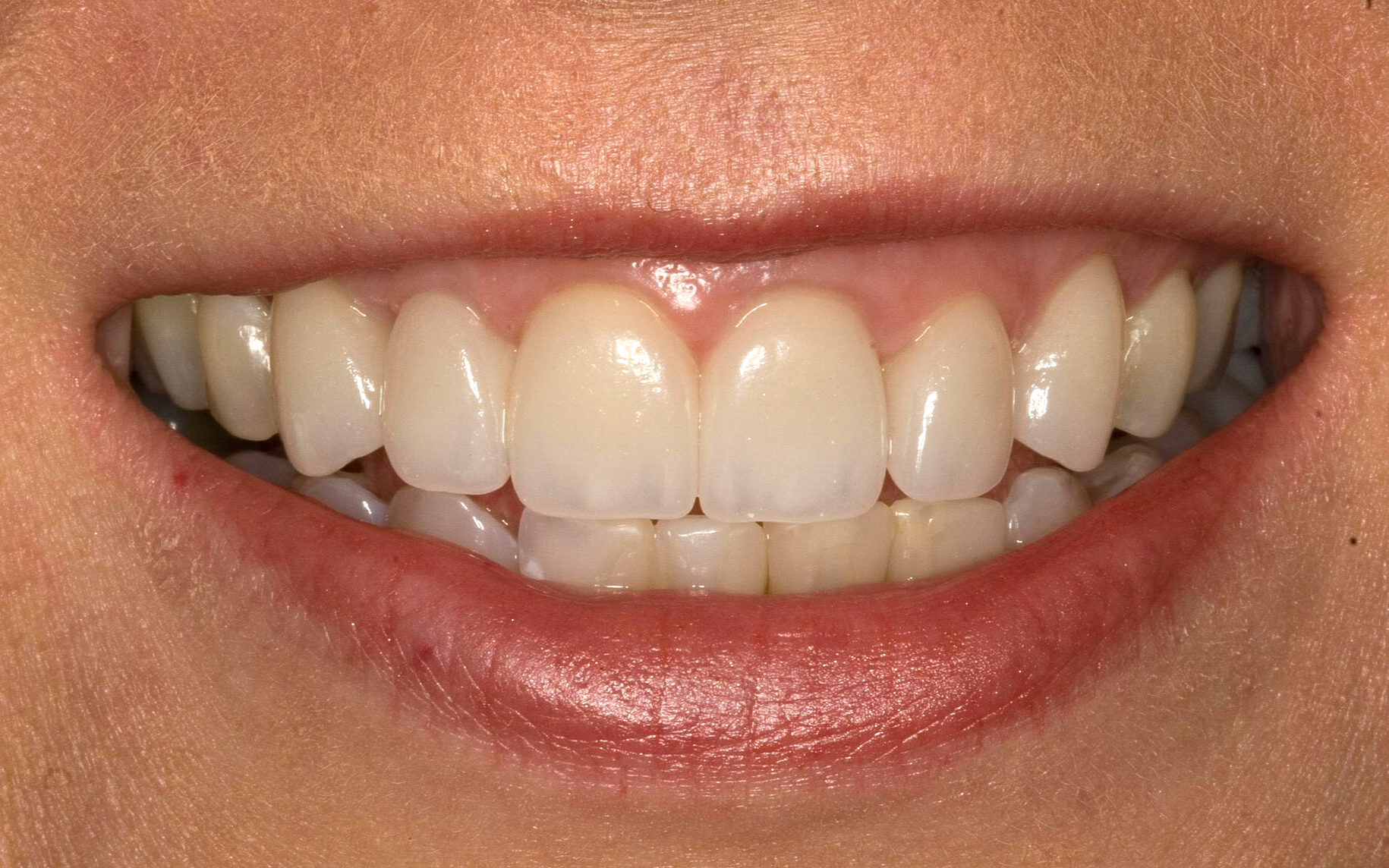 Close-up of a smiling mouth showing straight white teeth and pink lips
