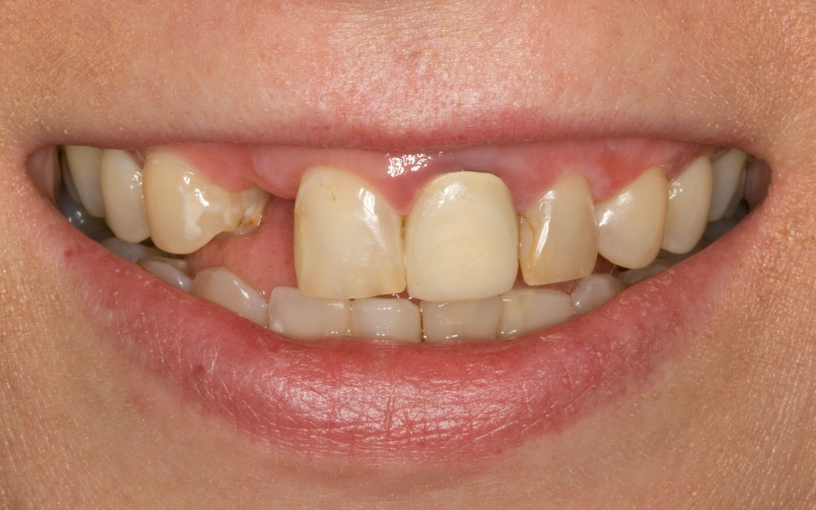 Close-up of a smiling mouth with a gap between the front teeth and visible off-white teeth