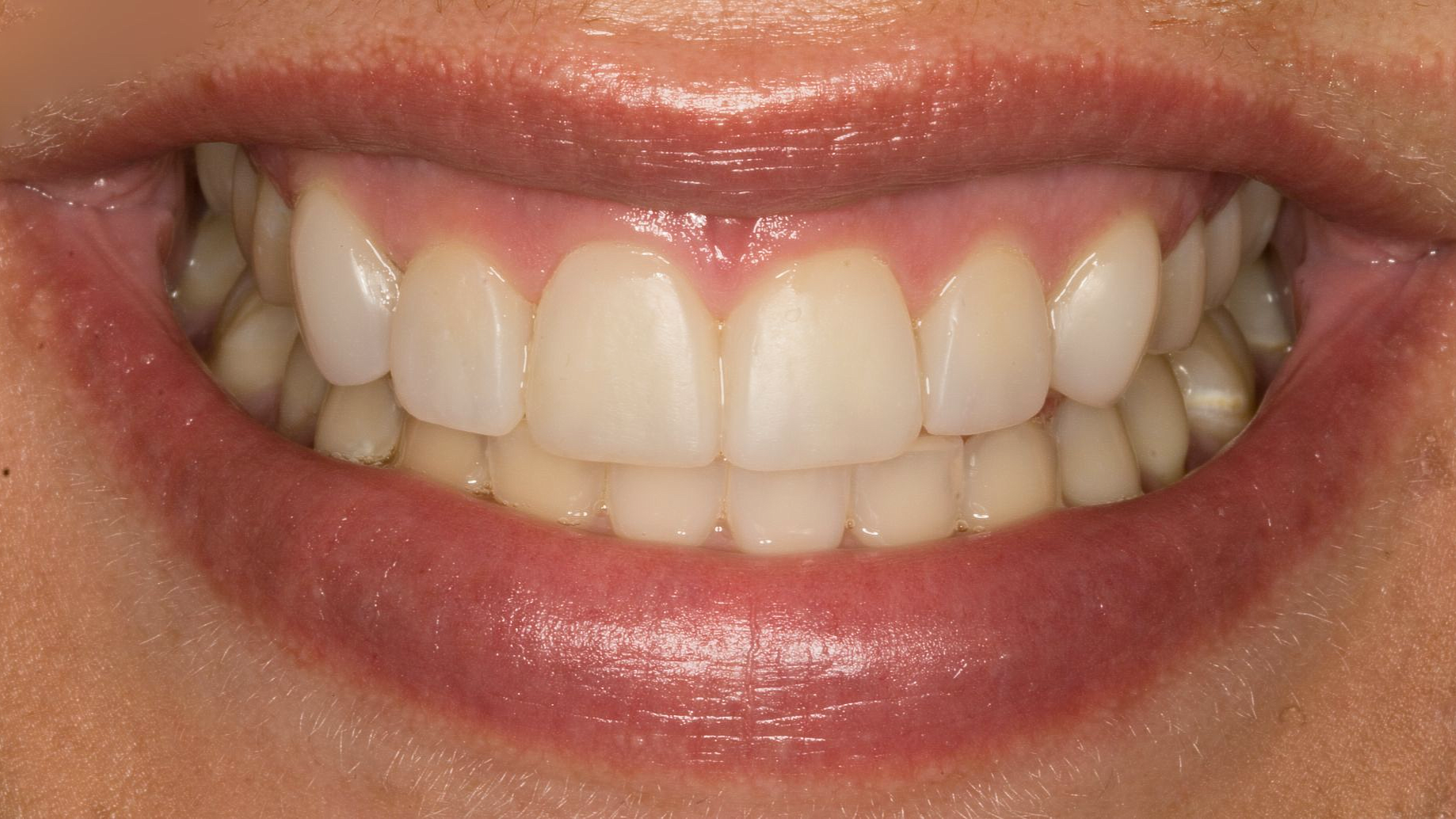 Close-up of a smiling mouth showing white teeth and pink lips