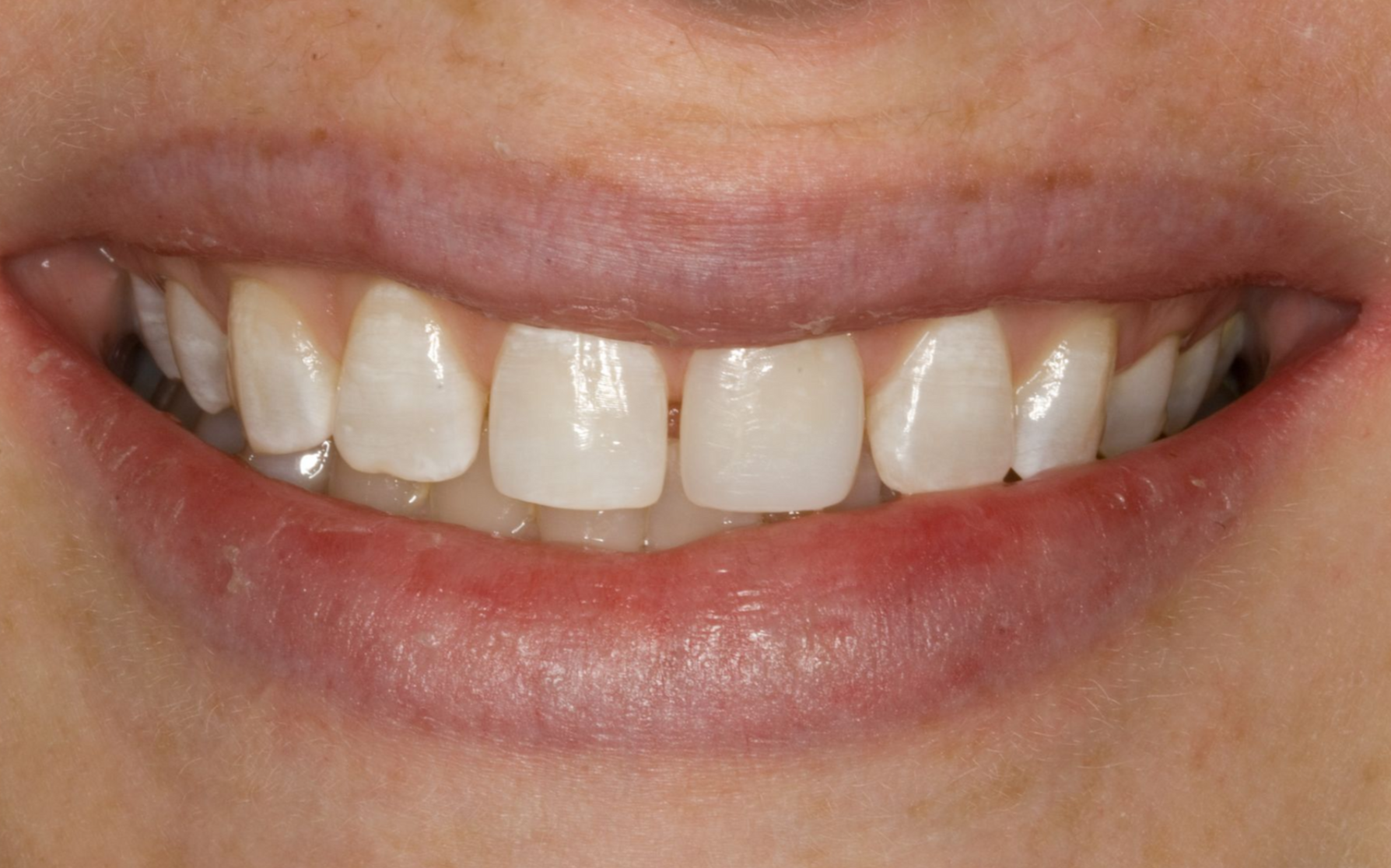 Close-up of a smiling mouth showing teeth and pink lips