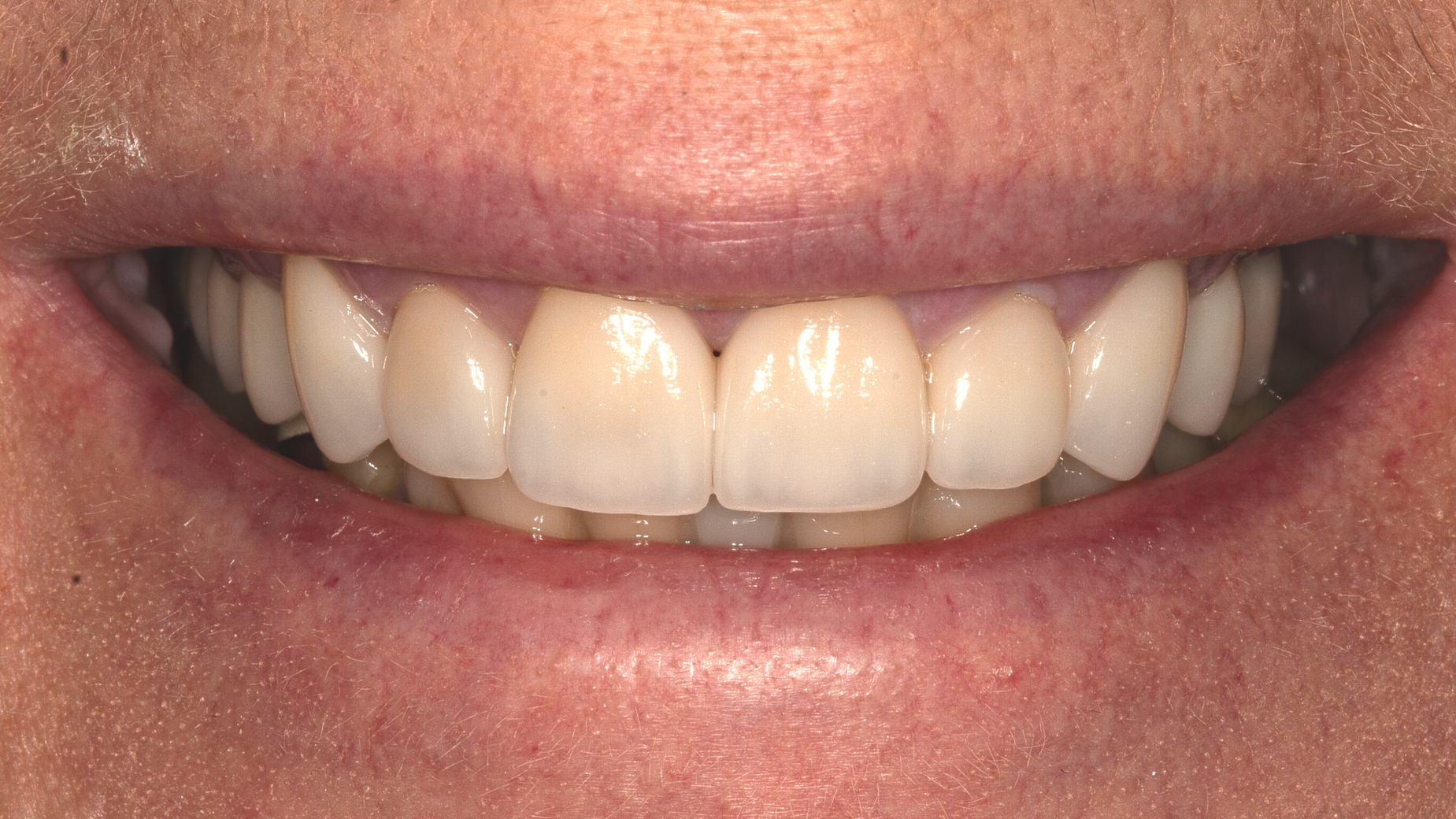 Close-up of a smiling mouth with straight white teeth and pink lips