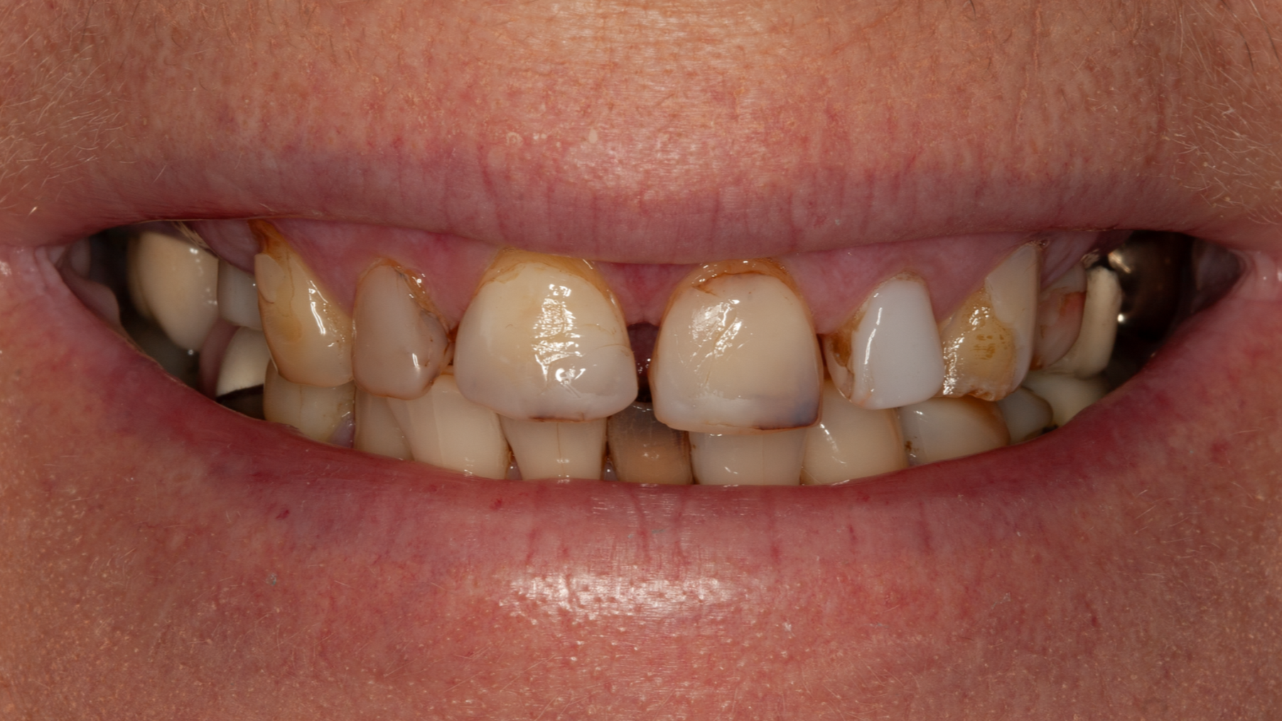Close-up of a smiling mouth with visibly crooked and stained teeth