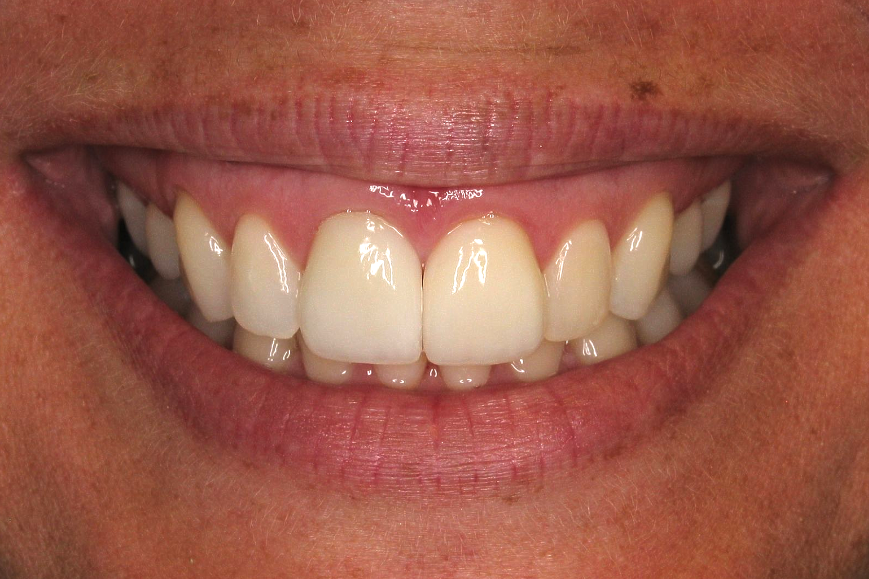 Close-up of a smiling mouth showing white teeth and pink lips