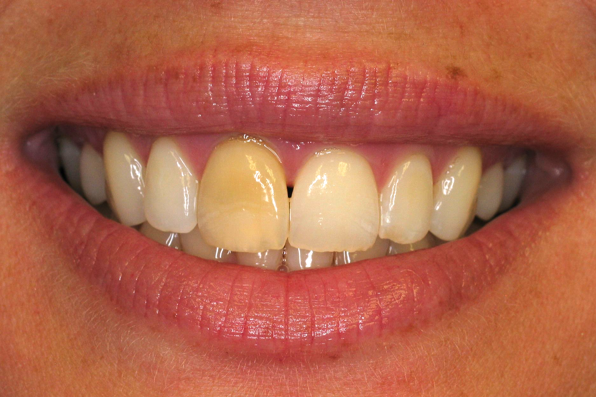 Close-up of a smiling mouth with uneven yellowed front teeth.