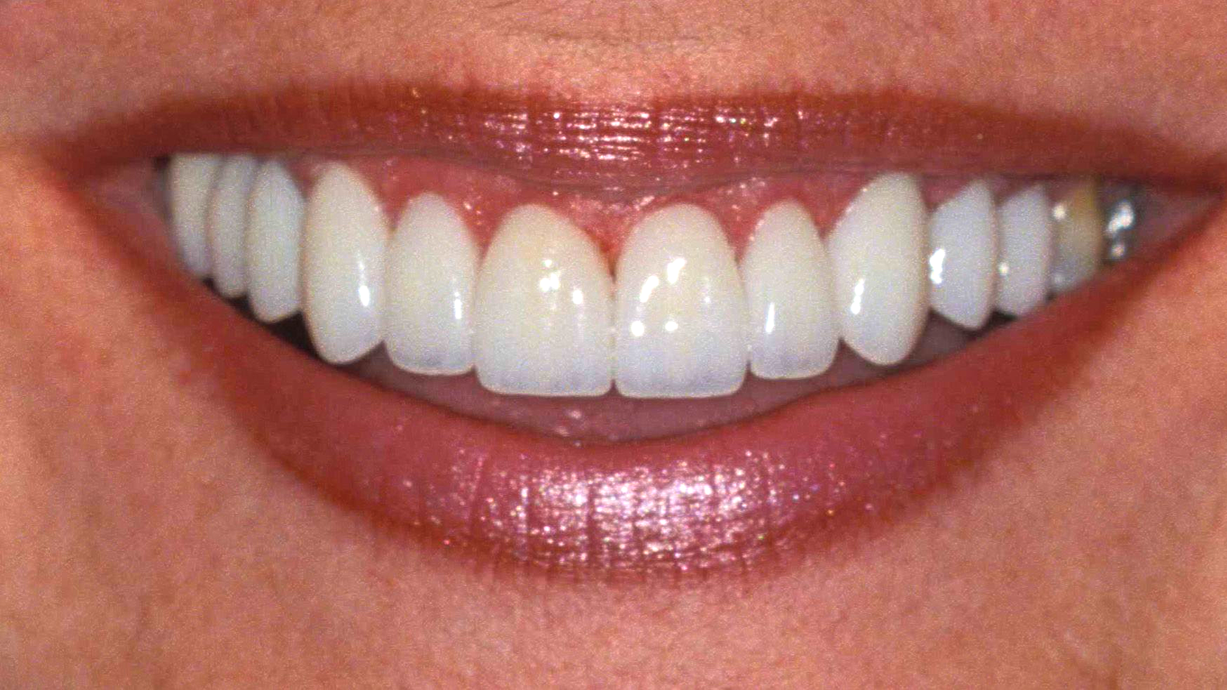 Close-up of a smiling mouth with glossy pink lips and bright white teeth