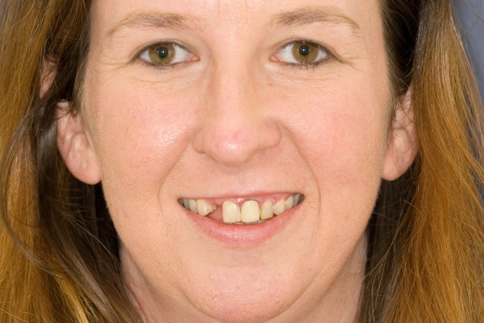 Close-up portrait of a smiling person with visible missing front teeth against a plain background