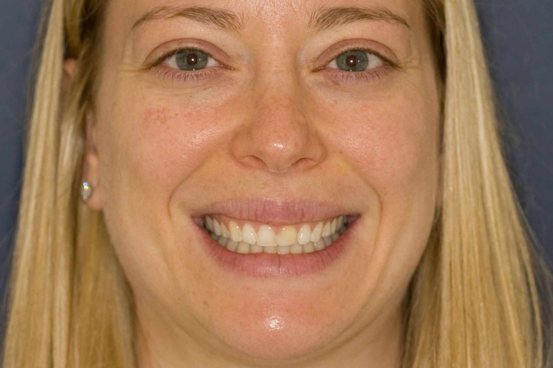 Close-up of a smiling blonde woman showing her teeth against a plain background