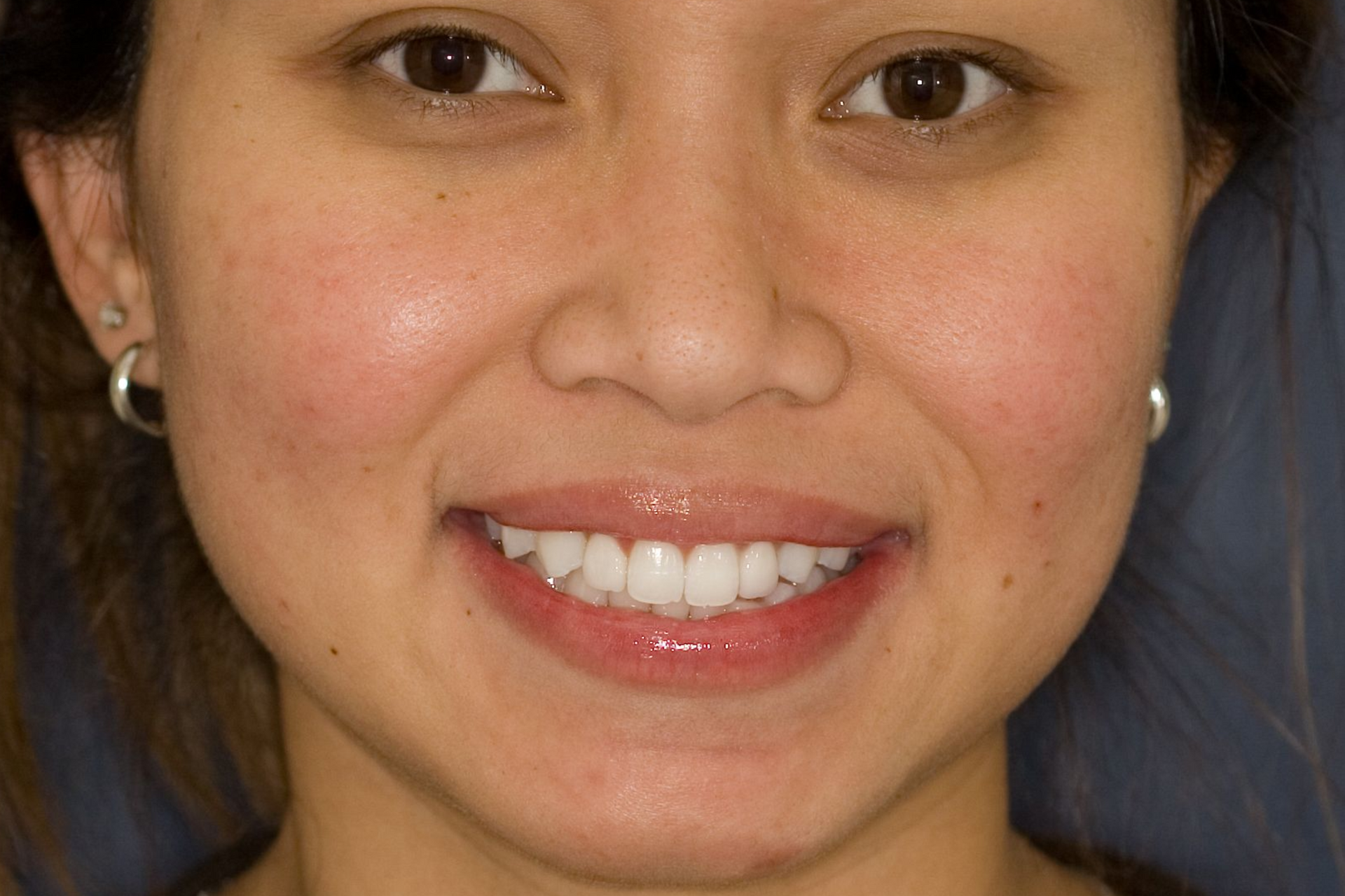 Close-up of a smiling person with braces against a blue background