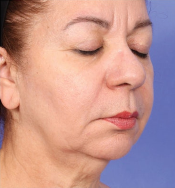 XERF Treatment