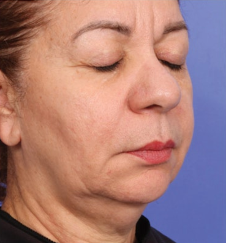 XERF Treatment