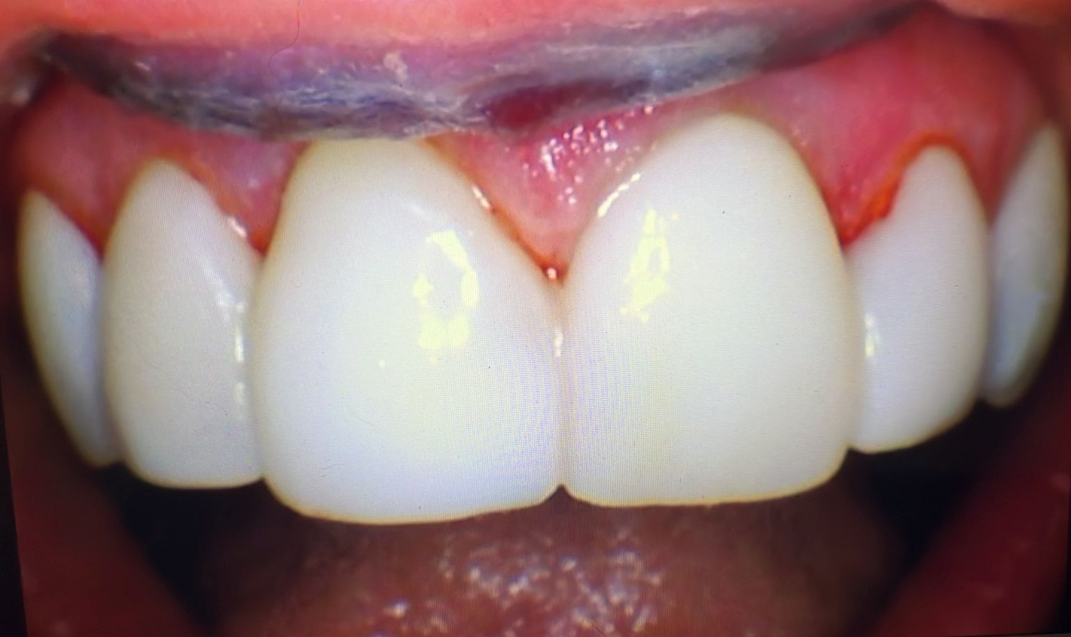 Teeth trauma treatment