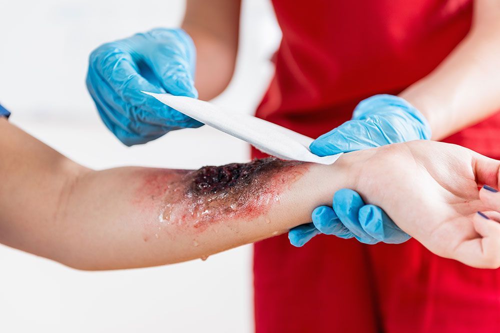 Person applying medical dressing to arm burn; gloved hands, red shirt.