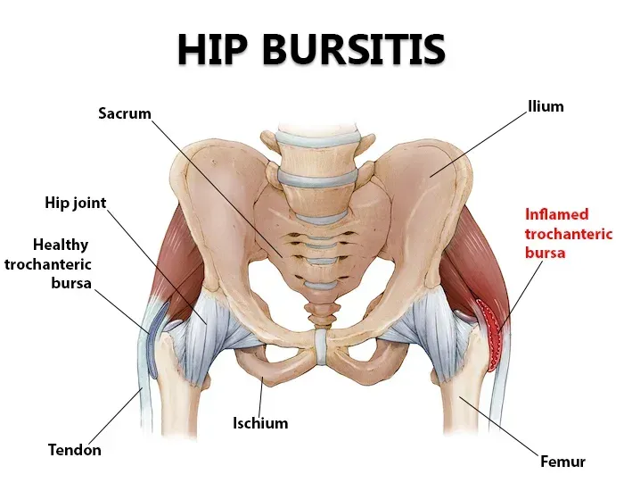 A diagram of a person 's pelvis showing the causes of hip bursitis.