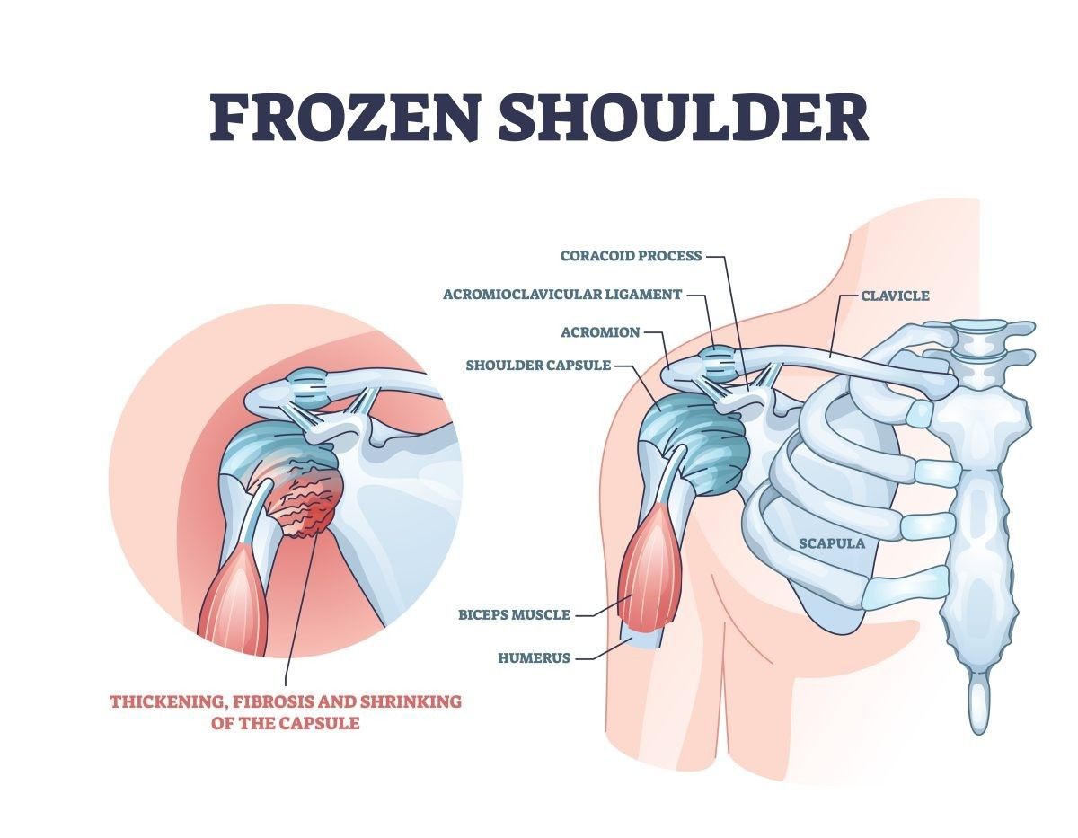 Diagram showing the anatomy of a shoulder with frozen shoulder. Red and blue colors highlight the affected area.