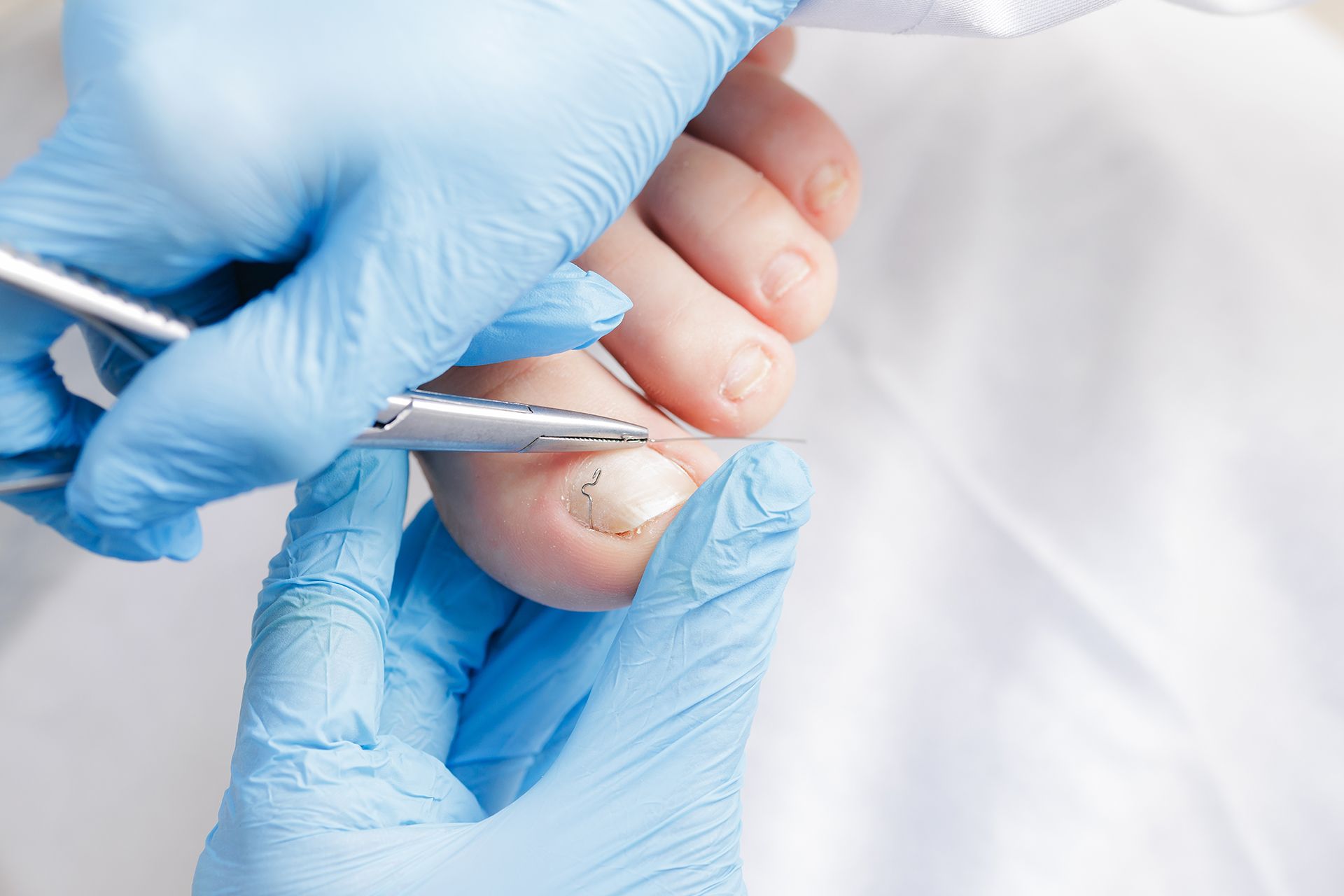Ingrown toenail treatment in Mississauga & Oakville: Causes, prevention & fast relief
