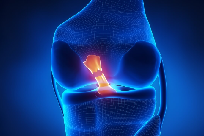 A computer generated image of a knee with a broken kneecap.