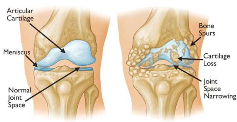 A diagram of a normal knee joint and a knee with arthritis
