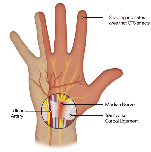 A diagram of a hand showing the ulnar artery and median nerve
