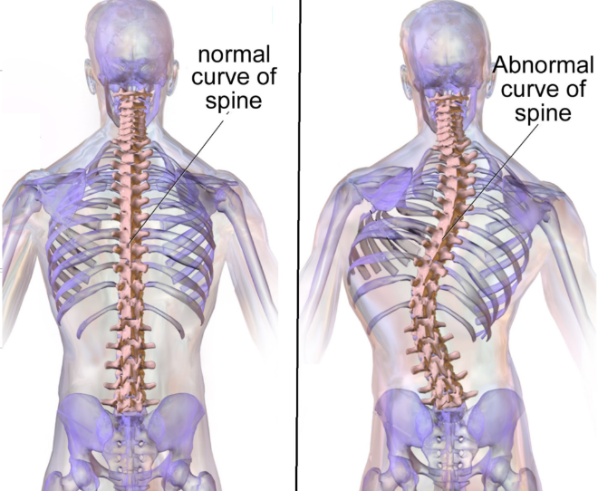An illustration of a normal curve of spine and an abnormal curve of spine
