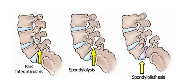 A diagram of a spine showing different types of spondylosis.