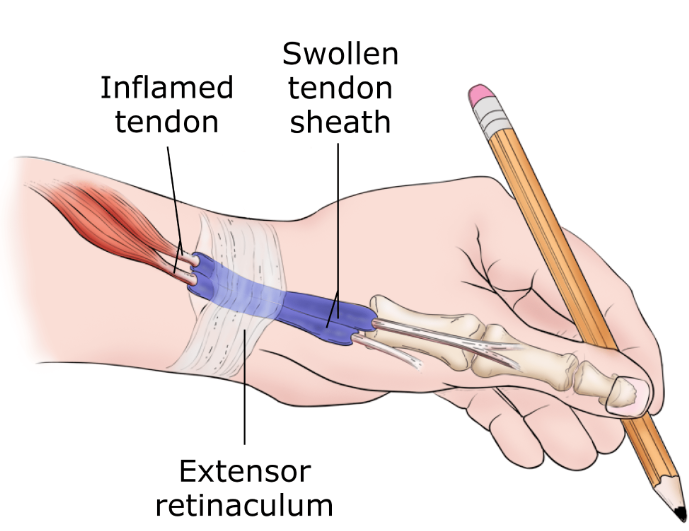 A drawing of a hand with a pencil and a swollen tendon