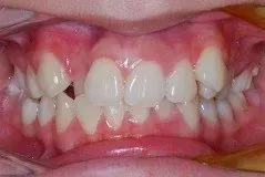 A close up of a person 's teeth with a broken tooth.