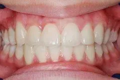 A close up of a person 's teeth with white teeth.