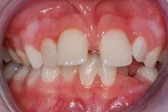 A close up of a person 's mouth with white teeth and red gums.