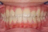 A close up of a person 's teeth with white teeth.