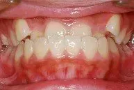 A close up of a person 's mouth with a lot of teeth.