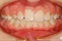 A close up of a person 's mouth with white teeth.