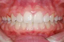 A close up of a person 's teeth with white teeth.