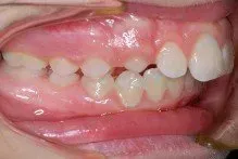 A close up of a person 's mouth showing their teeth.