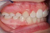 A close up of a person 's mouth with white teeth and red gums.