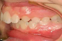 A close up of a person 's teeth and mouth.