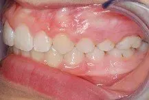 A close up of a person 's teeth with a mouth guard.