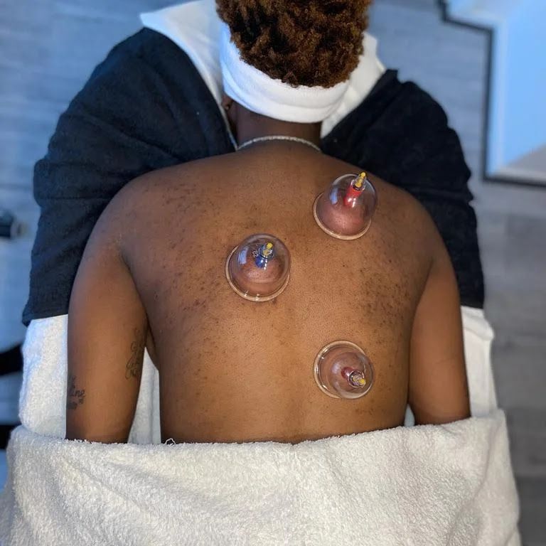 Een cupping behandeling op de rug bij Mixed Skins in Dordrecht.